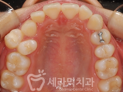 과개교합 치아교정잘하는곳, 세라믹치과 치아교정전후! 관련 이미지 16