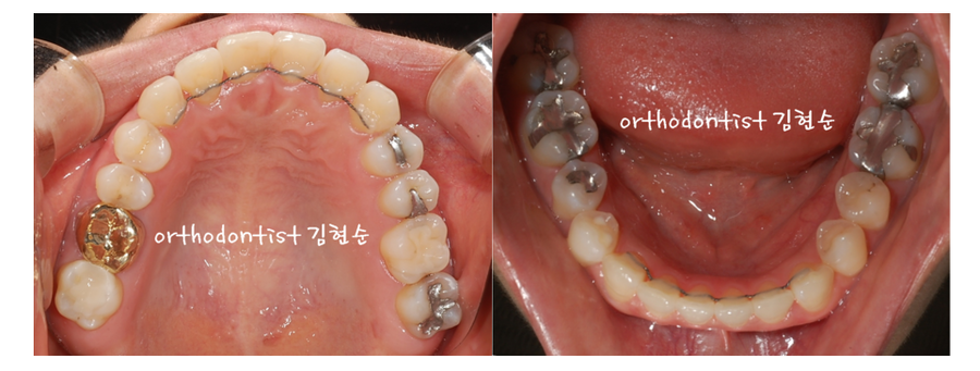 안면비대칭 교정, 치아교정만으로 간단히 해결하기 관련 이미지 14