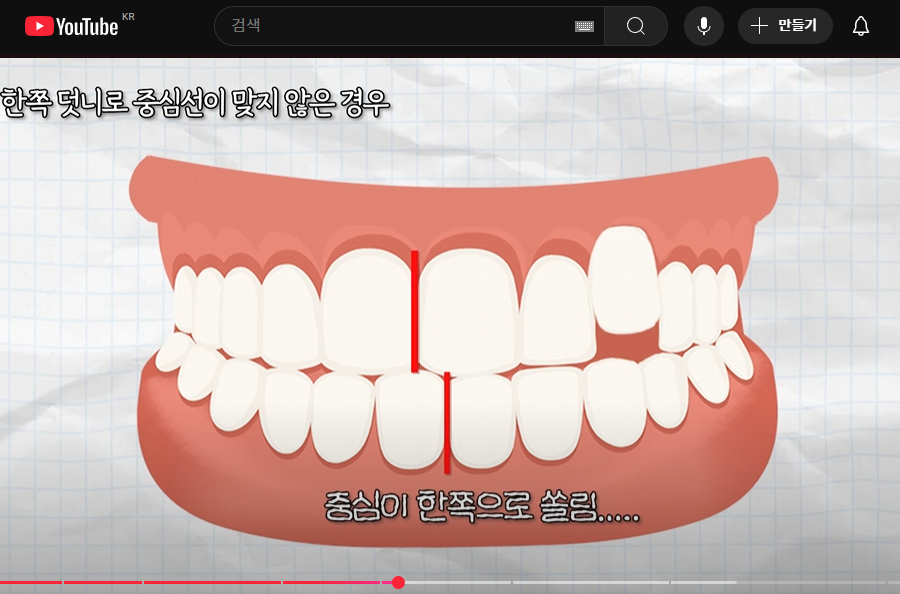 앞니 중심선 안맞으면, 안면비대칭인가요? [치아교정 필요한 예시] 관련 이미지 3