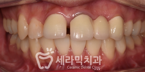 돌출입 치아벌어짐 치아재교정 전후. 세라믹치과 관련 이미지 4