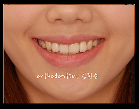강남교정치과 관련 이미지 32
