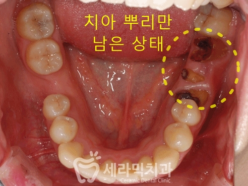 돌출입, 치열불규칙, 치아상실 치아교정과 임플란트 전후 관련 이미지 4