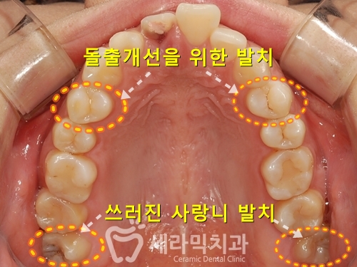 깨진 후에 후회하는 돌출입, 치아교정으로 건강하고 가지런한 치아만들기 관련 이미지 6