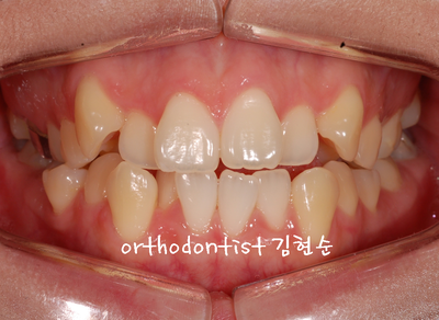 치열 교정(치열 불규칙) 관련 이미지 3