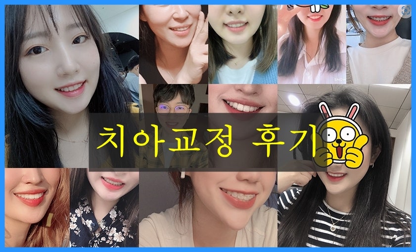 치아배열 치아교정전후 : 함박웃음을 찾은 사례 관련 이미지 7