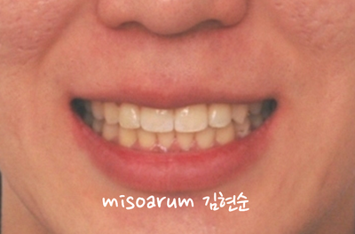 반대교합 관련 이미지 24