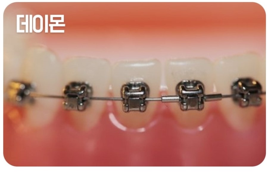 세라믹교정 클리피씨 데이몬 차이점 요약 관련 이미지 7