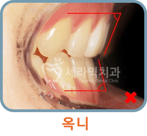 옥니 없이 치아교정잘하는곳, 강남 세라믹치과 관련 이미지 4