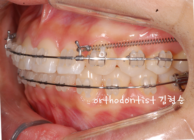 돌출 교정 (비발치 교정/비대칭) 관련 이미지 25