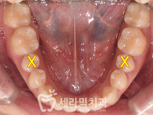 혀내밀기 습관과 개방교합, 오픈바이트(Open bite) 치아교정전후 보기 관련 이미지 9