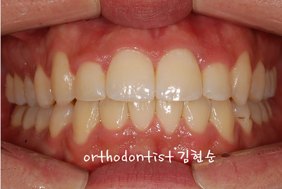 반대교합 관련 이미지 18