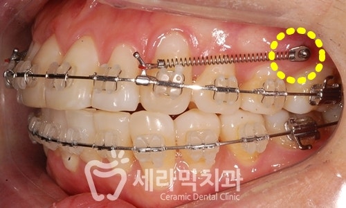 성인교정, 40대 50대 치아교정 잘하는 세라믹치과 치아교정전후 관련 이미지 5