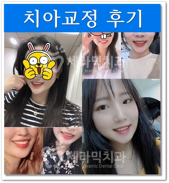 교정 전 어색한 웃음이 치아교정전후 함박웃음으로 변하게 된 사례 관련 이미지 7