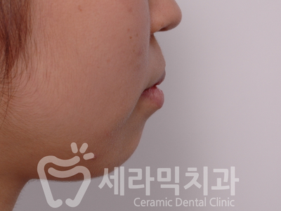 치아교정 전후 확연한 인상 변화! 관련 이미지 6