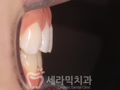 앞니 돌출, 나비치아를 남몰래 해결한 치아교정 전후! 관련 이미지 24
