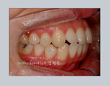 강남교정치과 관련 이미지 19