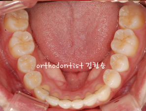 강남 돌출입 교정 관련 이미지 23