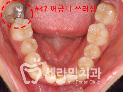 토끼이빨, 틀어진 치아배열 세라믹교정 전후사진 관련 이미지 13
