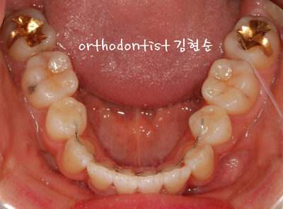 강남 덧니 관련 이미지 25