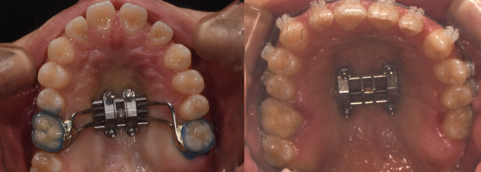학동역 교정치과, 개방교합과 비대칭을 수술없이 교정한 경우 관련 이미지 8