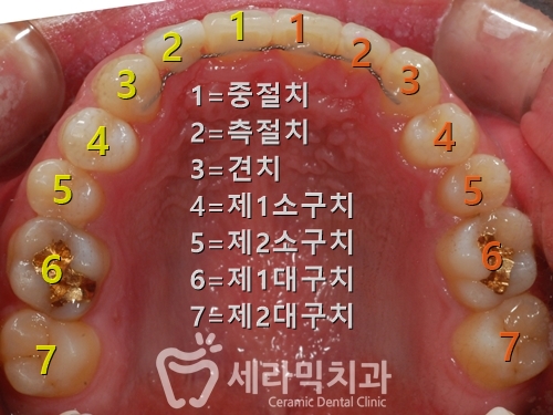 돌출입 투명교정 치아교정전후 관련 이미지 2