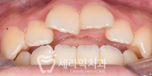 혀내밀기 습관과 개방교합, 오픈바이트(Open bite) 치아교정전후 보기 관련 이미지 2