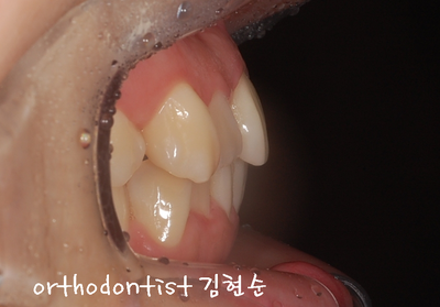 강남 덧니, 돌출 관련 이미지 5