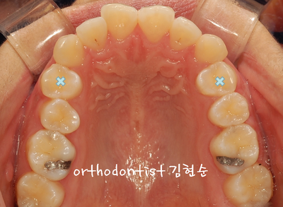 강남 돌출 관련 이미지 12