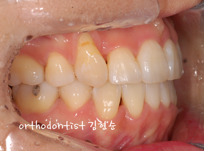 강남 덧니 관련 이미지 22