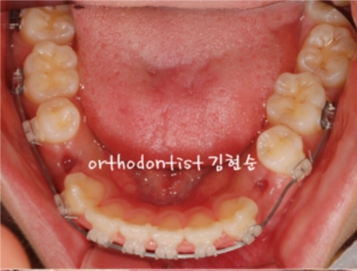 강남치아교정추천 관련 이미지 29