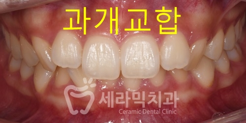 앞니돌출과 과개교합 치아교정전후, 세련된 이미지로 변신! 관련 이미지 1