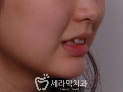 토끼이빨 돌출입 치아교정 전후 표정변화! 관련 이미지 6