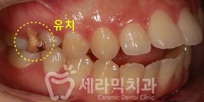 돌출입과 개방교합 치아교정 치료전후 관련 이미지 7