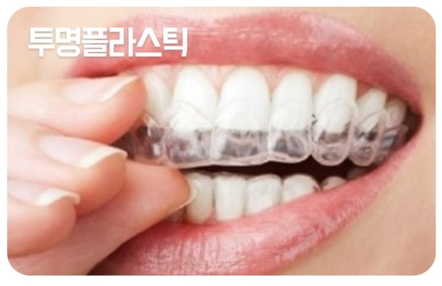 세라믹교정 클리피씨 데이몬 차이점 요약 관련 이미지 12