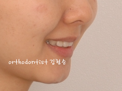 돌출 교정 (비발치 교정/비대칭) 관련 이미지 32