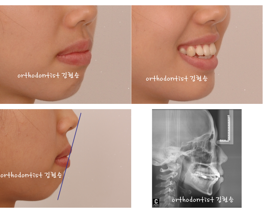 세라믹교정 세라믹치과-돌출입발치교정 6 관련 이미지 2
