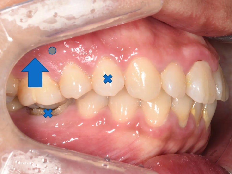 돌출입 교정 전후, 그런데 과개교합까지 있으셨던 환자분 관련 이미지 11