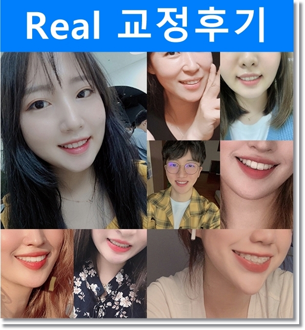 돌출입 치아교정전후 세련된 옆라인을 되찾다! 관련 이미지 3