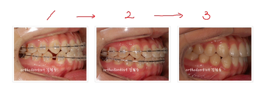 주걱턱수술 안하고 양악수술 안하고 관련 이미지 14
