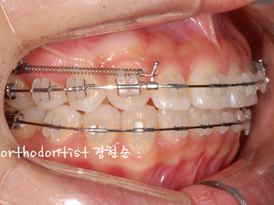 돌출 교정 (비발치 교정/비대칭) 관련 이미지 24