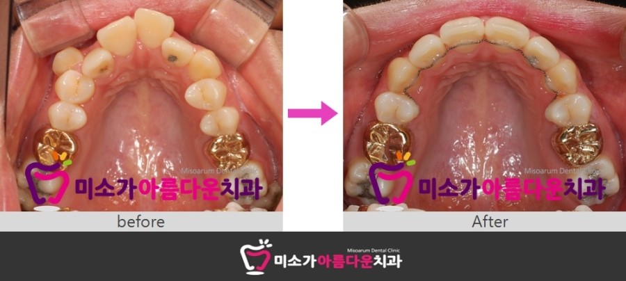 세라믹교정 덧니교정 세라믹치과에서 ~~ 관련 이미지 5