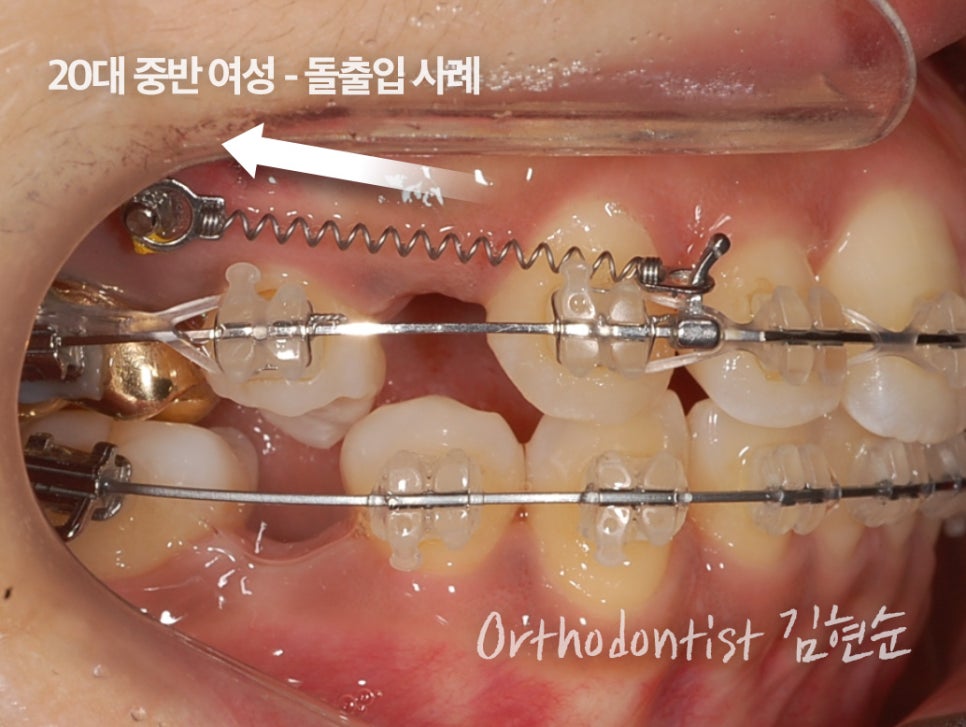 학동역치과 치아교정은 여기서 !! 관련 이미지 6