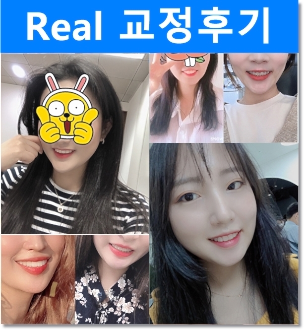 나비치아, 앞니돌출, 과개교합 치아교정전후 관련 이미지 8