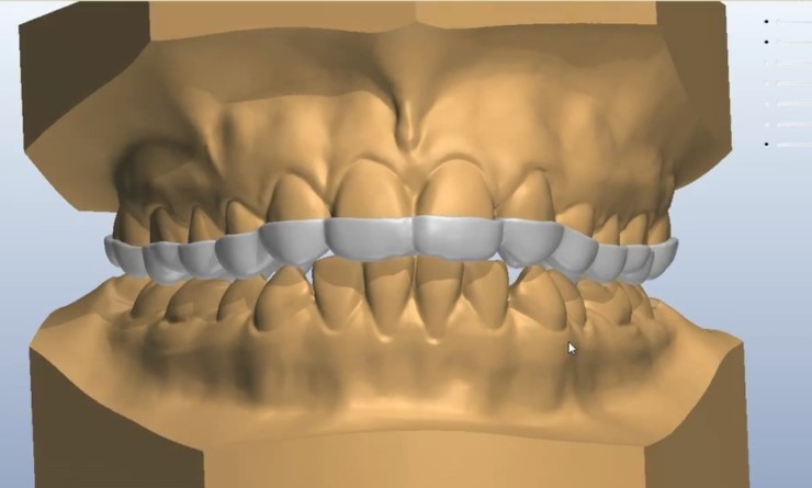 김현순원장의 3D miso 교정 (3D 미소교정) 관련 이미지 6