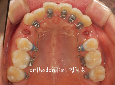 강남 돌출 관련 이미지 17