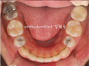 강남 돌출입 교정 관련 이미지 23