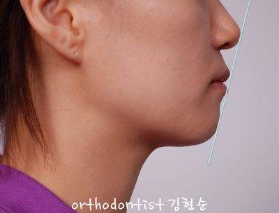 강남 덧니 관련 이미지 3