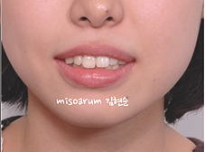 강남 돌출입 교정 관련 이미지 15