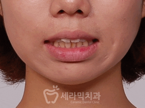 돌출입교정만 했을 뿐인데, 얼굴형과 무턱까지 개선된 치아교정전후 관련 이미지 3