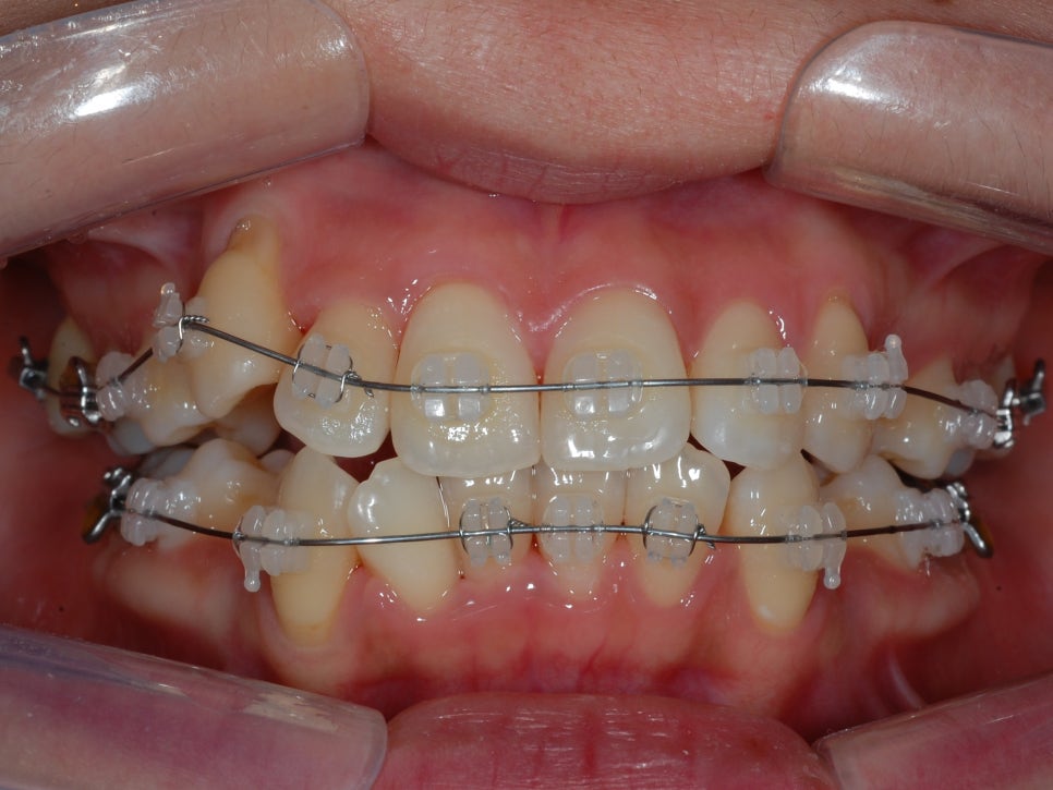 학동역치과 세라믹교정 특징은? 관련 이미지 6